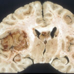 1200px-Glioblastoma_macro