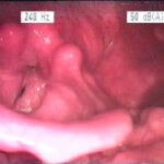 Laryngitis_gastrica