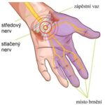 SO_Carpal_Tunnel1