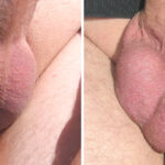 Scrotum
