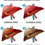 Stages of liver disease leading to Cirrhosis