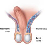 varikokela