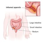 8095-appendicitis