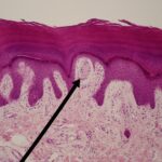 WVSOM_Meissner’s_corpuslce