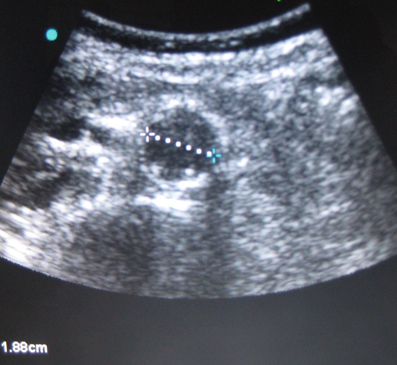 UZ abdominální aorty: průměr 1,9 cm (norma)