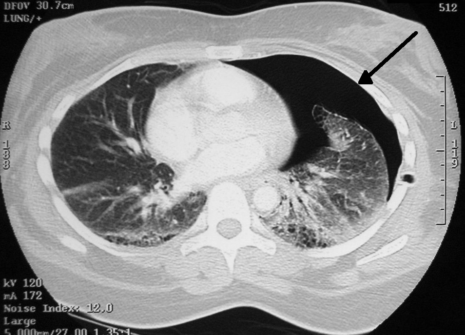 CT snímek levostranného pneumotoraxu