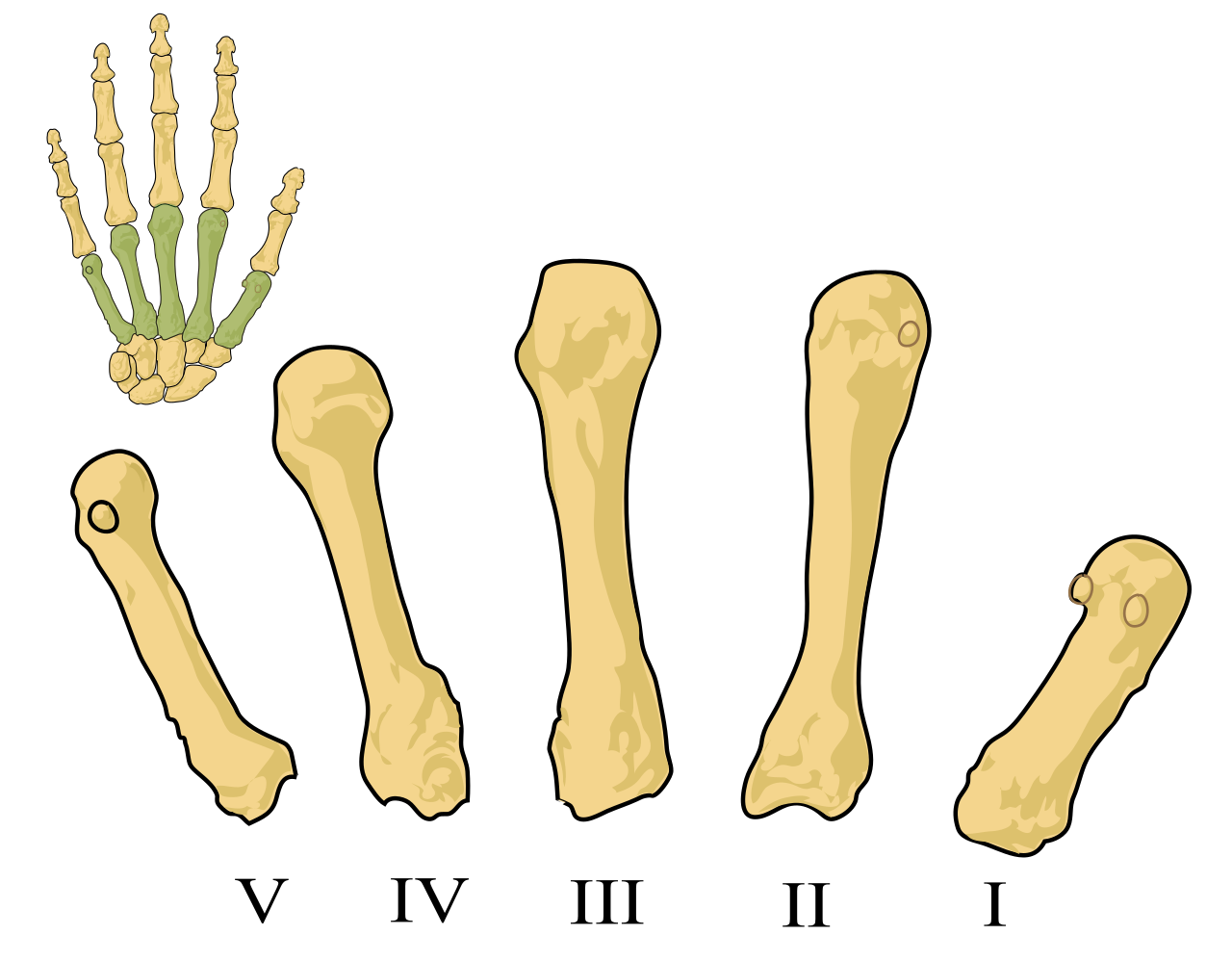 Pět záprstních (metakarpálních) kůstek levé ruky, označených římskými čísly I. až V.