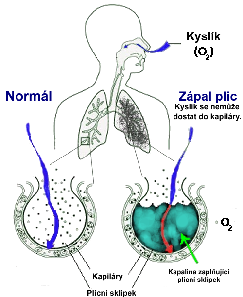 A schematic diagram of the human lungs with an empty circle on the right representing a normal alveola and one on the right showing an alveola full of fluid as in pneumonia