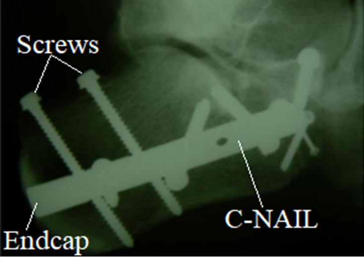 fractura, calcaneus, C-Nail, rtg