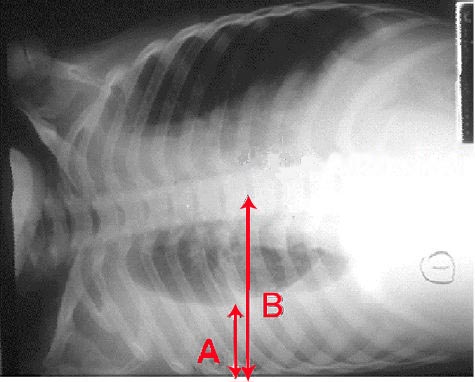 An X-ray showing a chest lying horizontal. The lower black area which is the right lung is smaller with a whiter area below it of a pulmonary effusion. There are red arrows marking the size of these.