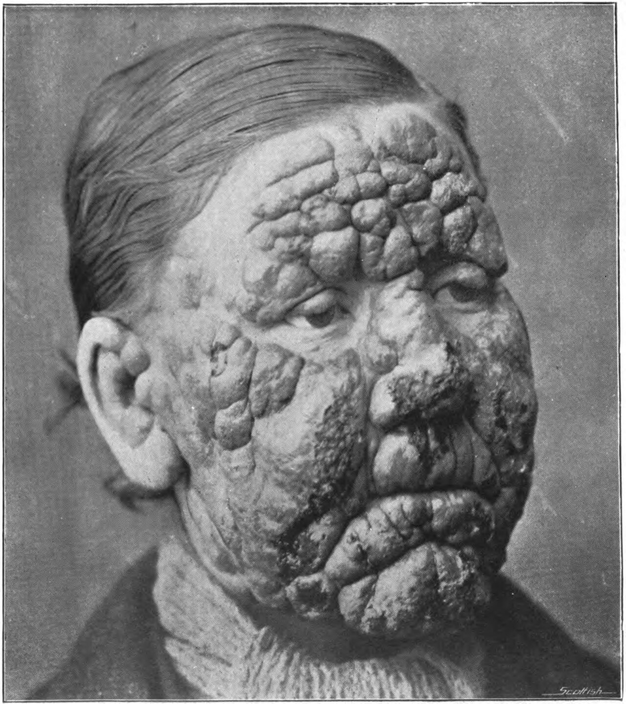 Kožní projevy malomocenství (1905)