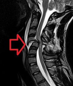 Obrázek magnetické rezonance poranění míchy v krční oblasti