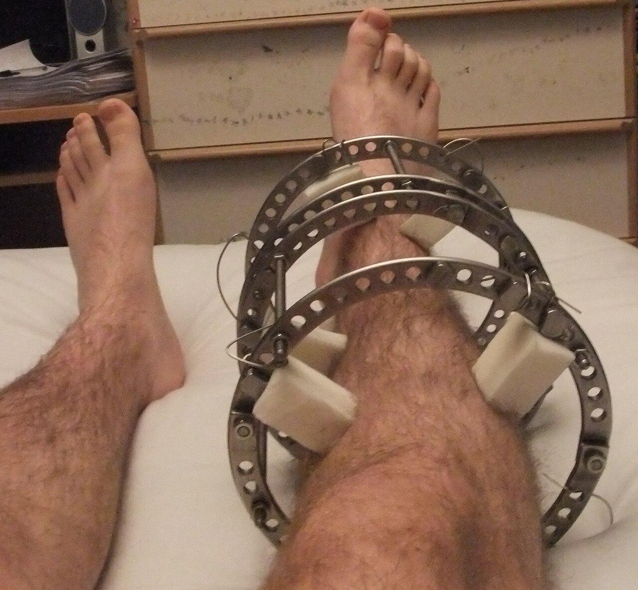 Ilizarevův fixátor (příklad zevní fixace) − léčba zlomeniny tibie