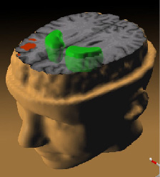 PET snímek zobrazující anatomické a neurofyziologické změny na mozku schizofrenního jedince; předpokládá se, že mnohé příznaky jsou zapříčiněny zmenšeným objemem čelního laloku (červeně) a naopak zvýšenou hladinou dopaminu ve striatu (zeleně)