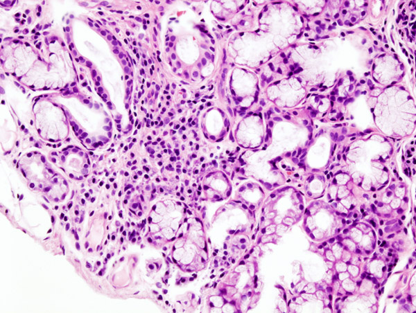Histopatologický snímek fokální lymfoidní infiltrace malé slinné žlázy při Sjögrenově syndromu; biopsie rtu