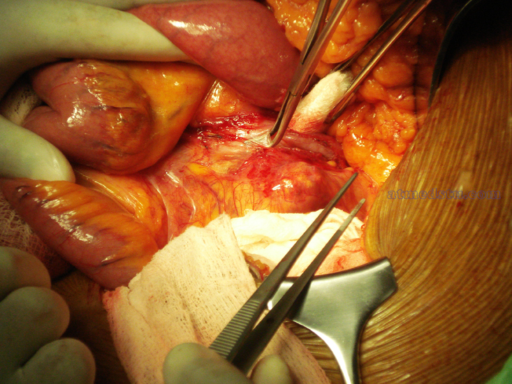 Chirurgie aneuryzmatu brišní aorty