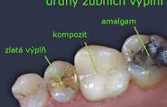 Druhy zubních výplní a jejich výhody a nevýhody